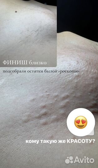 Модели на электроэпиляцию Apilus, Evolution 7HD