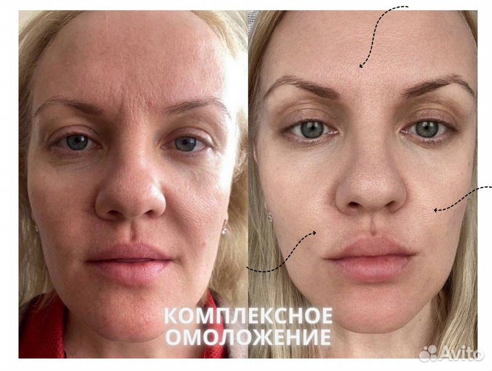 Комплексная программа омоложения лица