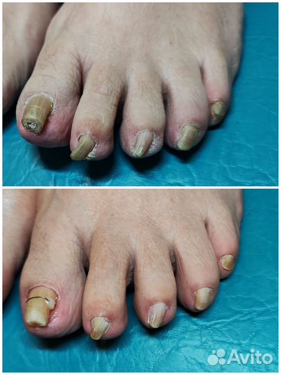 Медицинский педикюр подолог