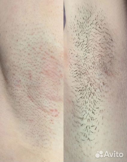 Электроэпиляция