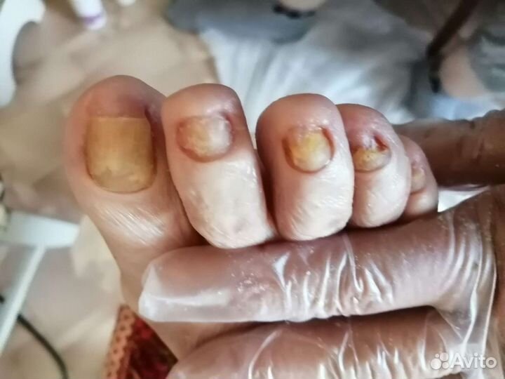 Подолог. Педикюр лечебный /мужской /женский/детски