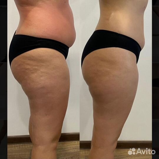 Массаж, антицеллюлитный массаж, аппаратный массаж