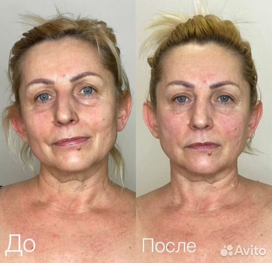 Массаж лица