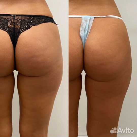 Массаж LPG коррекция фигуры