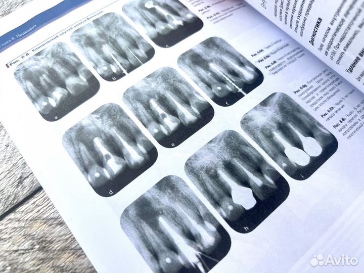 Травма зубов