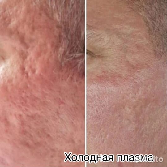 Холодная плазма