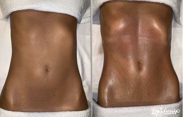 Коррекция силуэта/Липолазер