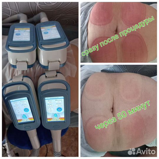 Криолиполиз Похудение без диет