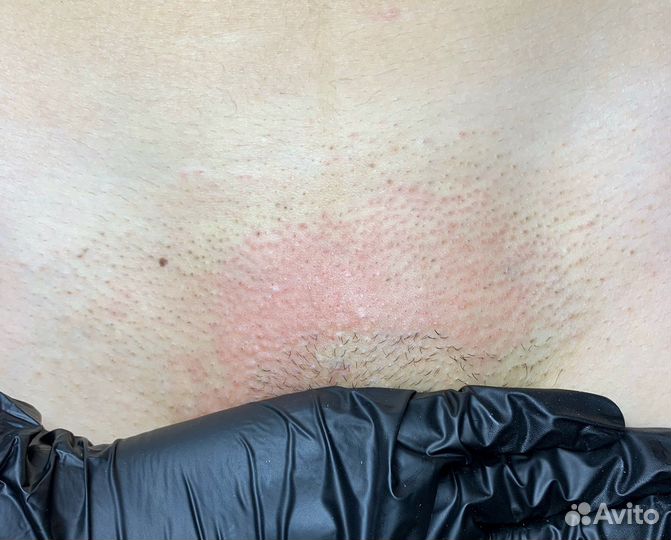 Услуга Электроэпиляции