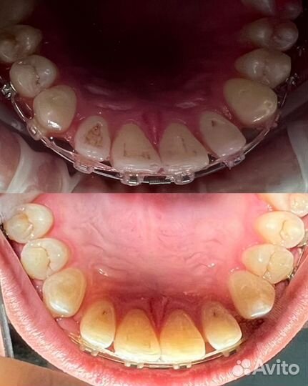 Купон на профессиональную гигиену рта