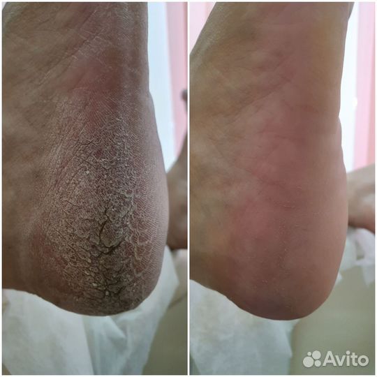 SMART - педикюр