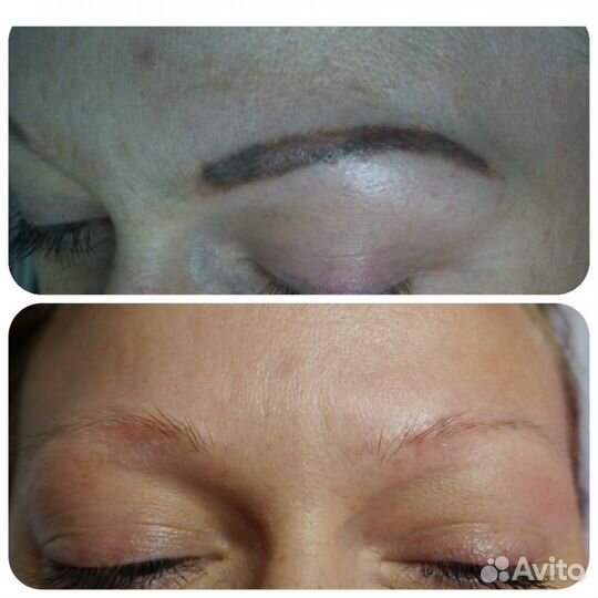 Лазерное удаление татуировок