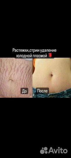 Сосуды.Шрамы.Рястяжки+Подтяжка