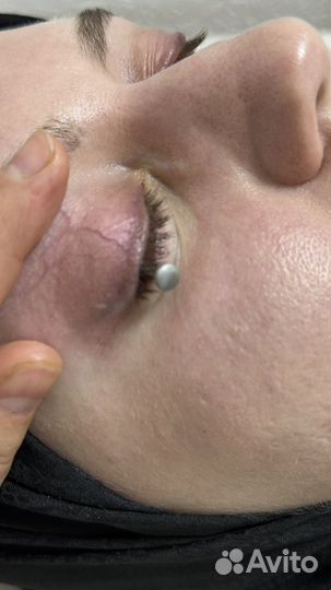 Удаление татуажа и татуировок