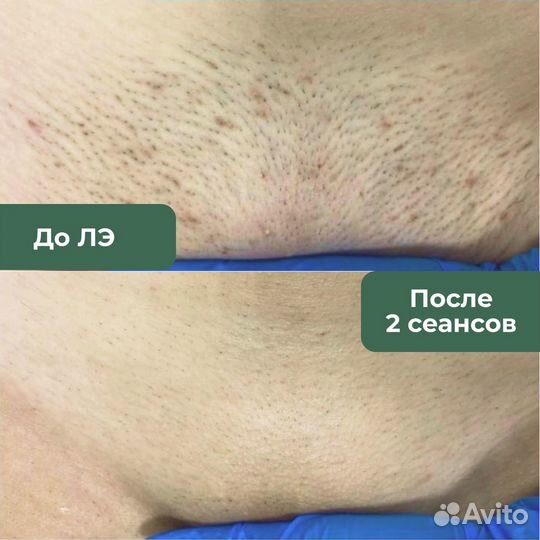 Лазерная эпиляция для женщин и мужчин по Зонам