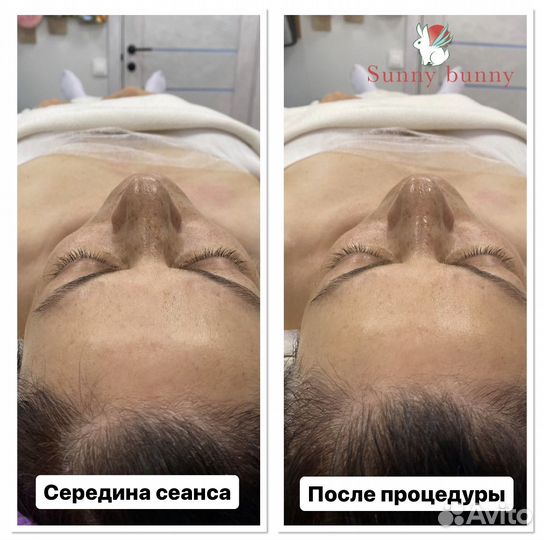 Массаж Противоотёчный, омолаживающий для лица