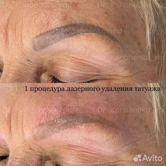 Удаление татуажа бровей