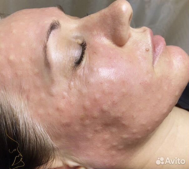 Косметолог Чистка лица, уколы красоты