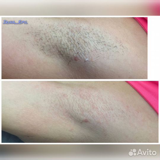 Электроэпиляция Apilus Ищу Моделей