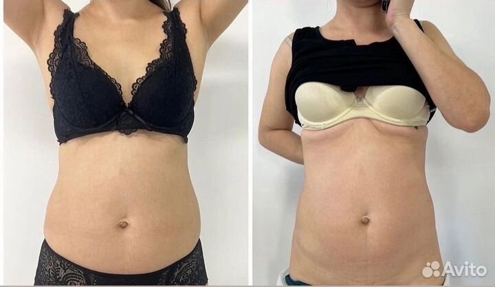 Массаж аппаратный антицеллюлитный