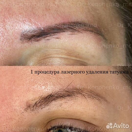 Удаление татуажа бровей