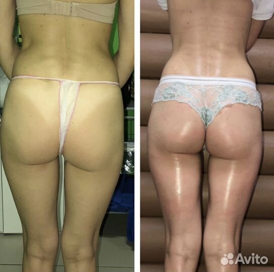 Антицеллюлитный массаж, массаж лица. Эффект сразу