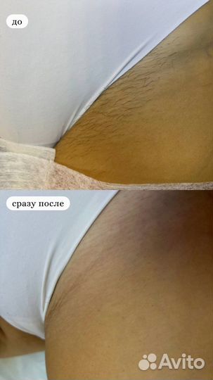 Электроэпиляция