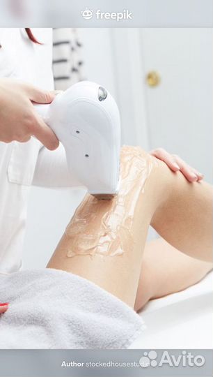Лазерная элос эпиляция на тополинке