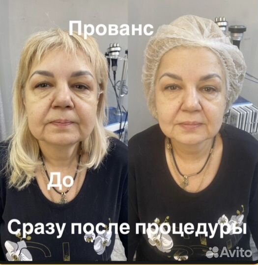 Модели на СМАС лифтинг