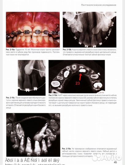 Хирургическое и ортодонтическое лечение ретинирова