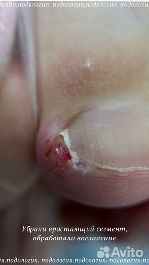 Подолог, вросший ноготь, титановая нить, педикюр