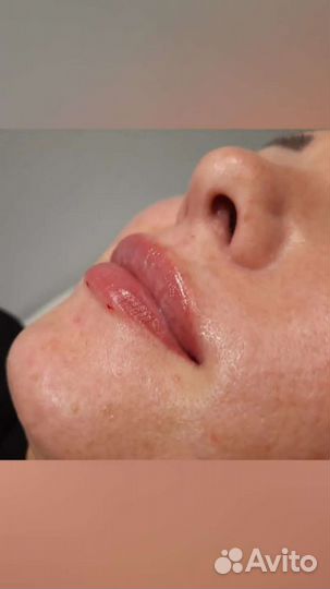 Контурная пластика губ