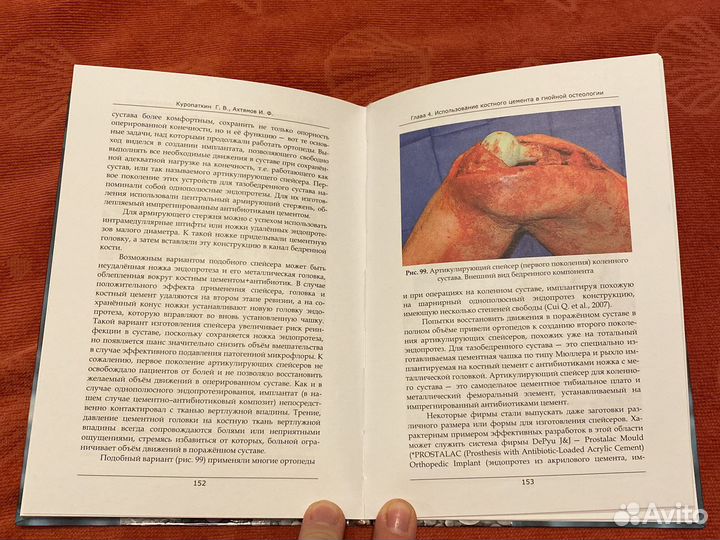 Костный цемент в травматологии и ортопедии