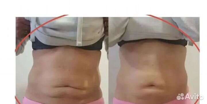 Криолиполиз в Самаре