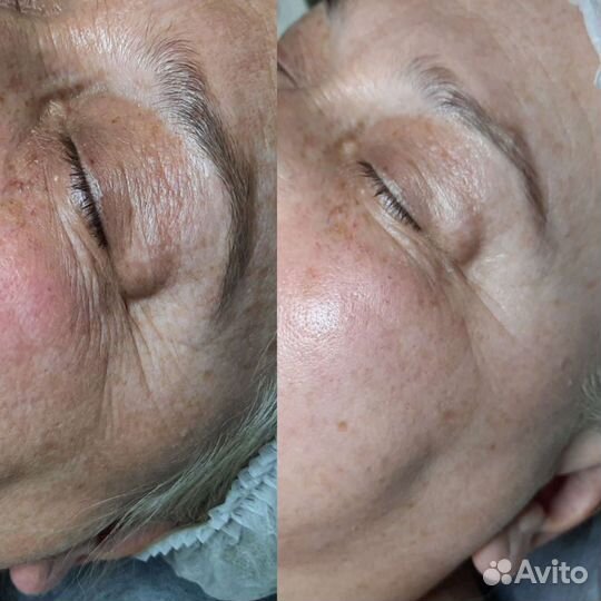 Косметология, контурная пластика