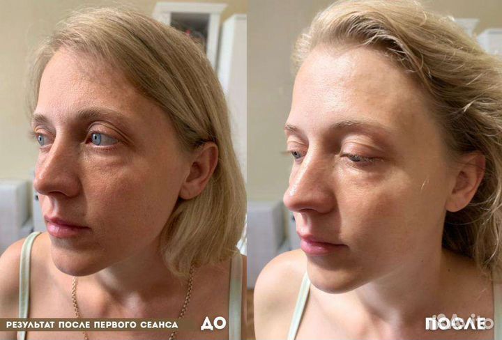 Миофасциальный массаж лица