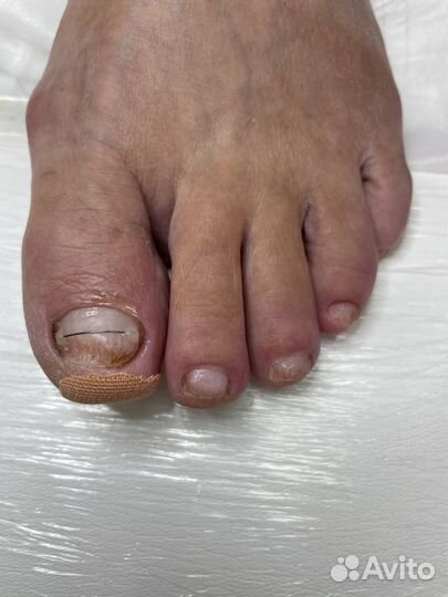 Препаратно-аппаратный педикюр Kane