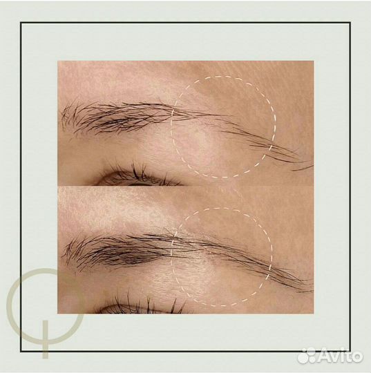 Восстановление роста волос бровей за 4 процедуры