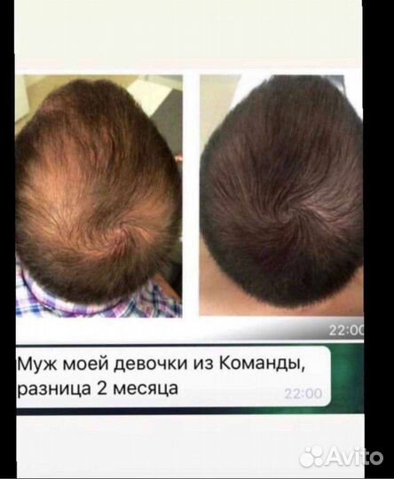 Сыворотка от выпадения волос