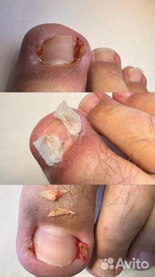 Педикюр подолог