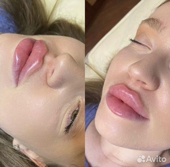 Увеличение губ ботокс