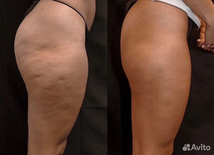 Прессотерапия