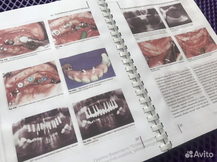 Регенеративные методы в имплантологии