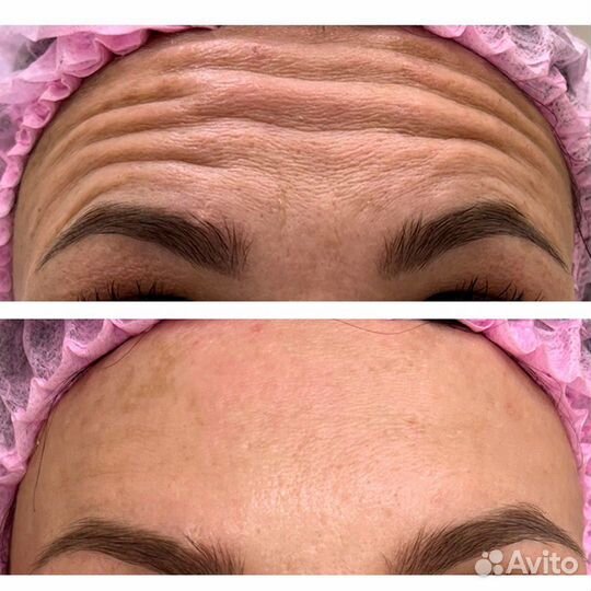 Ботокс/Ботулинотерапия