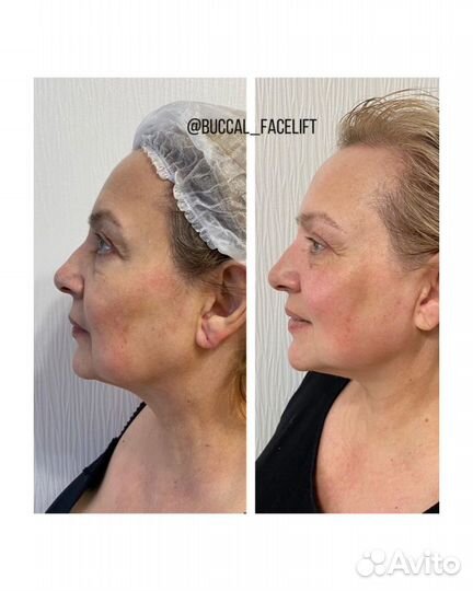 Буккальный массаж лица