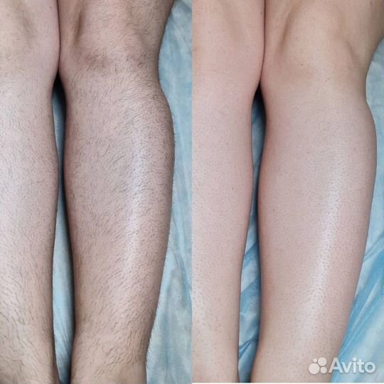 Лазерная эпиляция