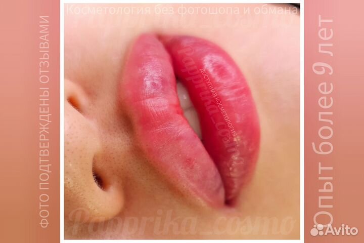 Косметолог увеличение губ