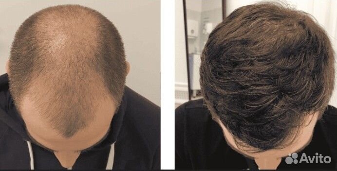 Пересадка волос, бороды Россия/ Турция