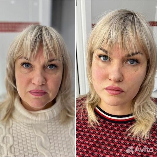 Подтяжка лица