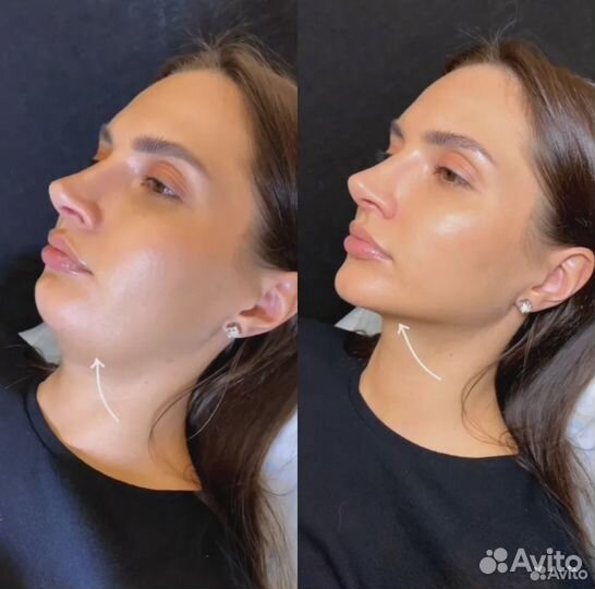 Подтяжка кожи за 1 процедуру. СМАС лифтинг. Омолож